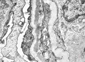 type I membranoproliferative glomerulonephritis